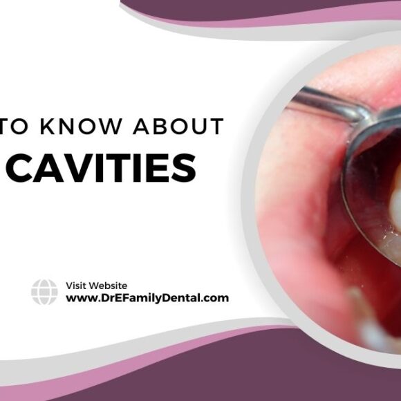 5 Things to Know About Cavities