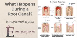 root-canal-image