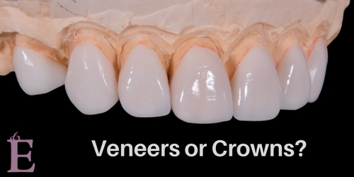 What’s the Difference Between Dental Veneers and Crowns?